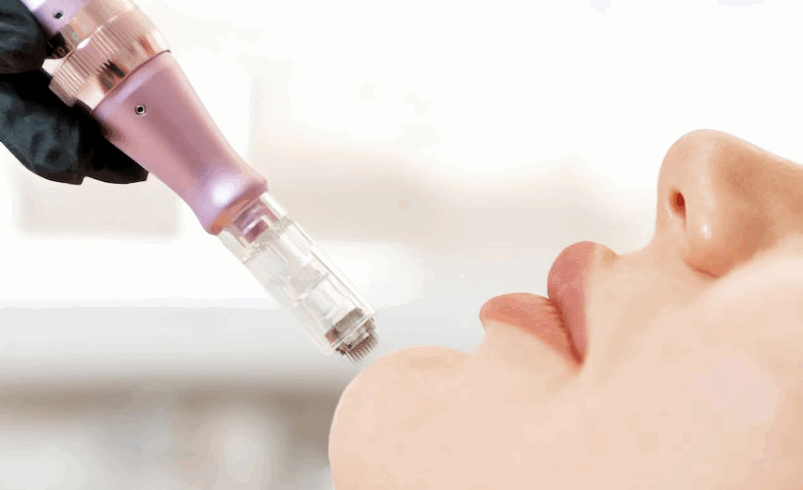 La revolución en el cuidado de la piel: Derma Pen, el secreto para una piel radiante